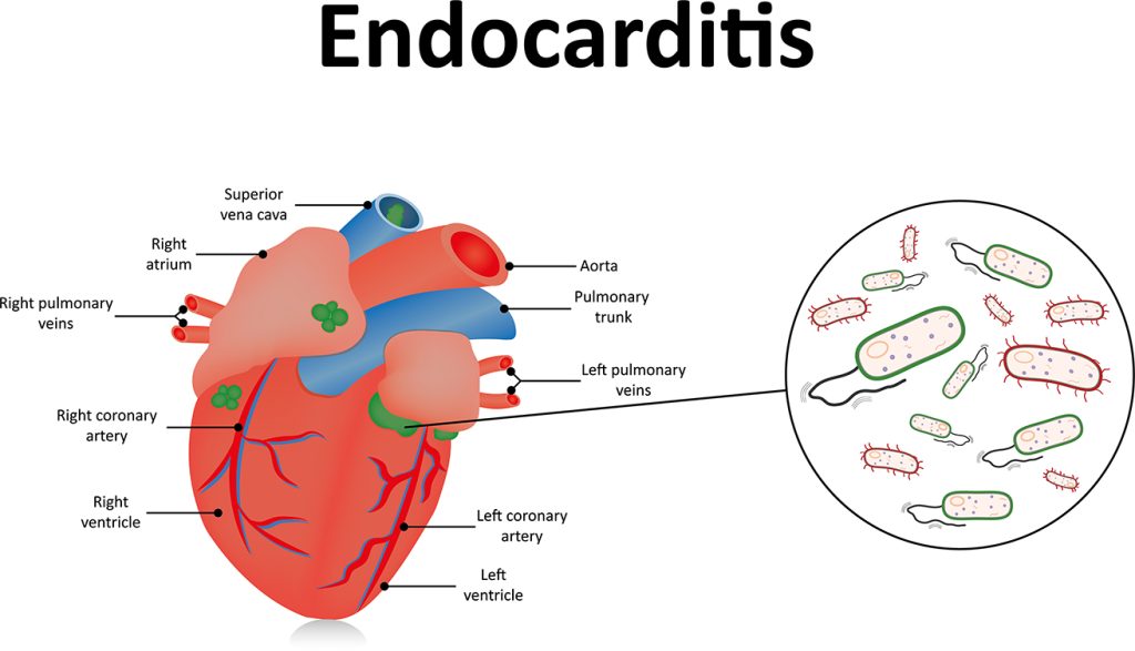 Endocarditis