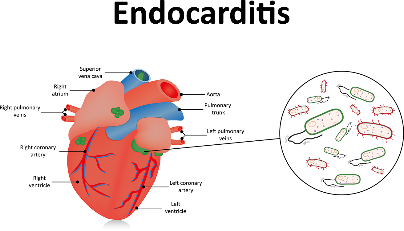 Endocarditis