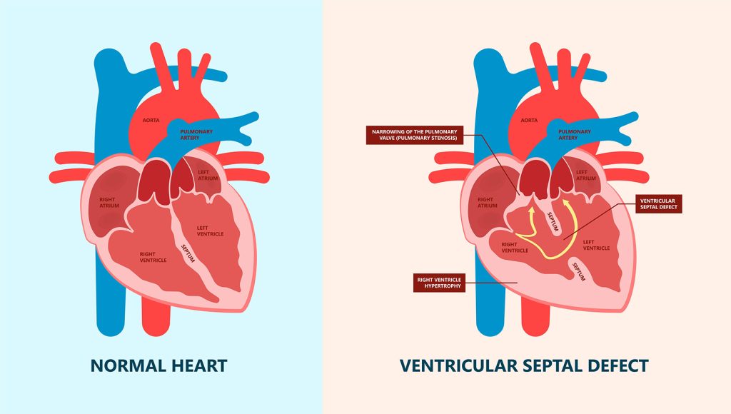 Ventricular Septal Defects